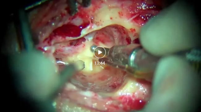 案例分享 | 人工耳蝸植入+迷路切除術